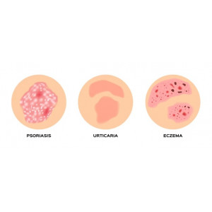 Eczema and Psoriasis