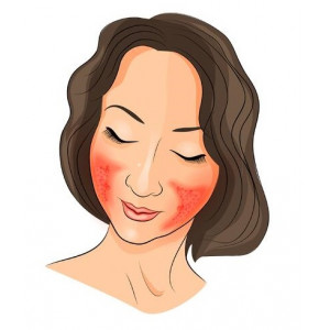 Rosacea