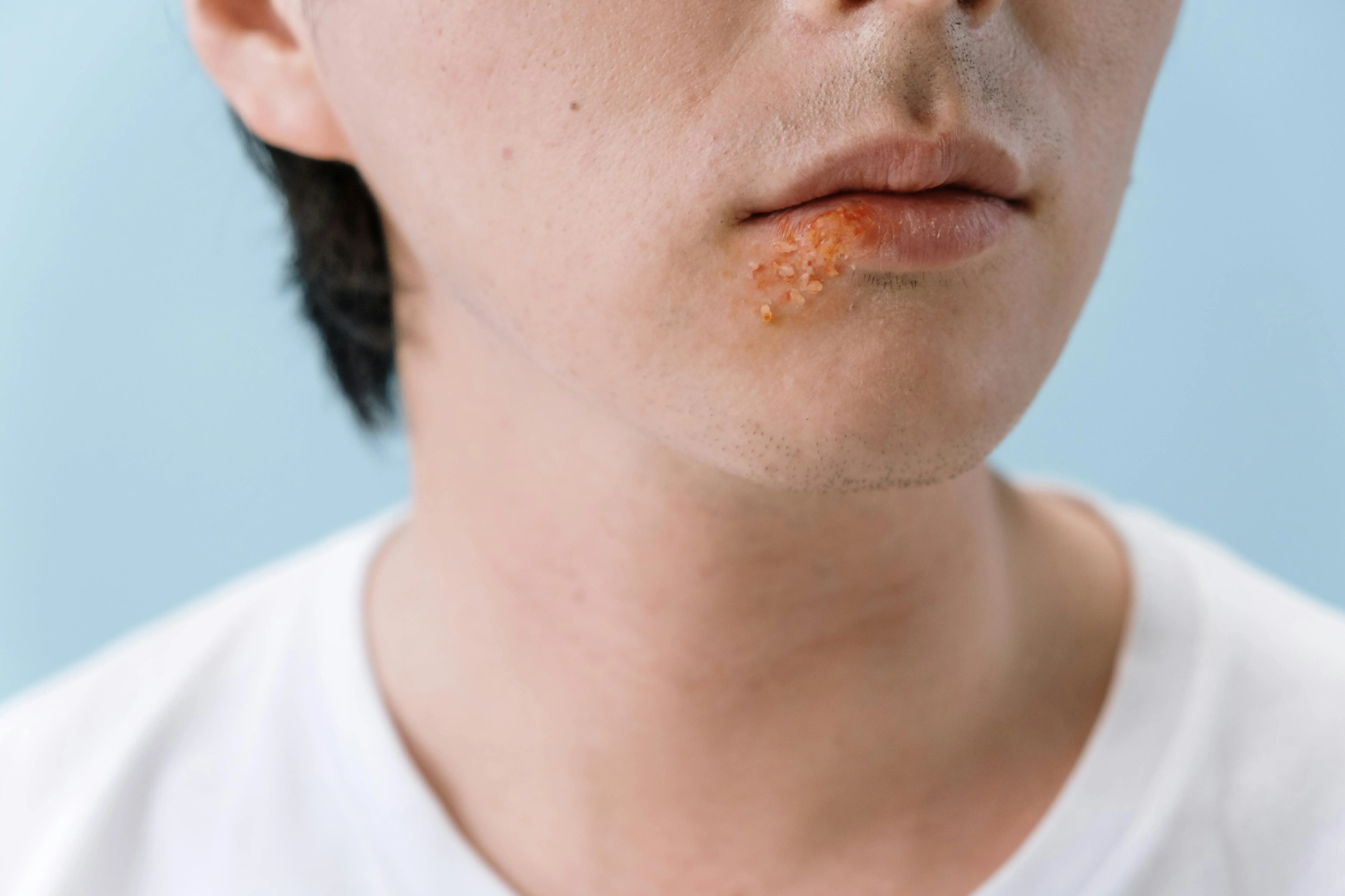 close up photo of persons mouth showing cold sore outbreak